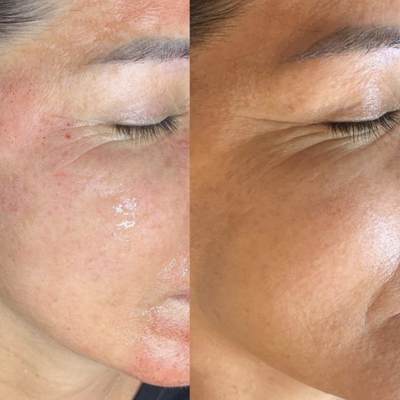 Microneedling - At The Sacred Glo, we specialize in customizing a holistic service that will overall enhance your inner well being and your outer beauty. We are experts in laser tattoo removal, hydrafacials, tattoo removal, microblading eyebrows, microneedling, fibroblast skin rejuvenation and more.
Call us today to get a free consultation! Microneedling - At The Sacred Glo, we specialize in customizing a holistic service that will overall enhance your inner well being and your outer beauty. We are experts in laser tattoo removal, hydrafacials, tattoo removal, microblading eyebrows, microneedling, fibroblast skin rejuvenation and more.
Call us today to get a free consultation!