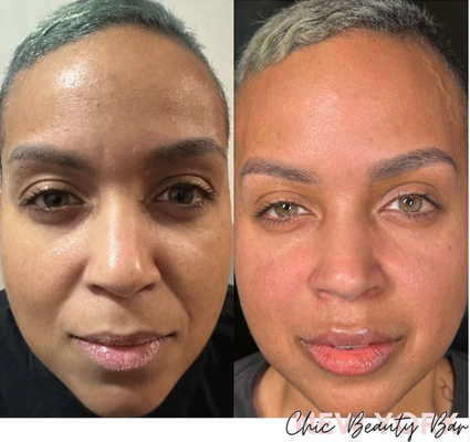 Botox Full treatment - Botox Full treatment