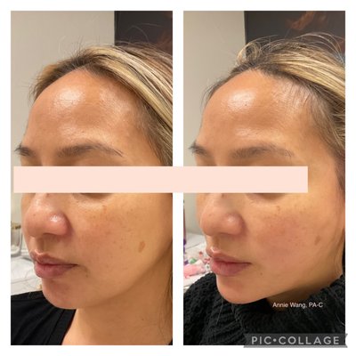 PDO Threadlift - Procedure takes about an hour. Clients may go back to normal activities immediately after. Call for a consultation! PDO Threadlift - Procedure takes about an hour. Clients may go back to normal activities immediately after. Call for a consultation!