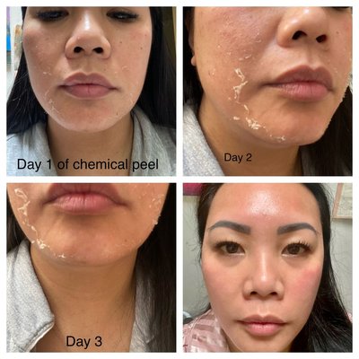 Chemical Peels - Chemical peels are exfoliating solutions that are customized for different skin types and incorporate a variety of active ingredients that work to exfoliate dead skin cells, improve pigmentation and reveal a new layer of skin. Depending on the depth of the peel, different layers of the skin will be targeted, and the peel may be applied differently. Chemical Peels - Chemical peels are exfoliating solutions that are customized for different skin types and incorporate a variety of active ingredients that work to exfoliate dead skin cells, improve pigmentation and reveal a new layer of skin. Depending on the depth of the peel, different layers of the skin will be targeted, and the peel may be applied differently.