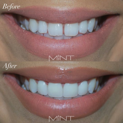 Veneers - Veneers Gallery Cases Veneers - Veneers Gallery Cases