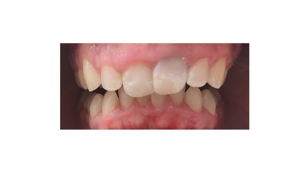 Making room! - Patient came in with crowded teeth. Teeth straightened with Invisalign.
