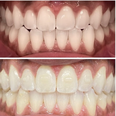 Invisaligns - Invisalign cases