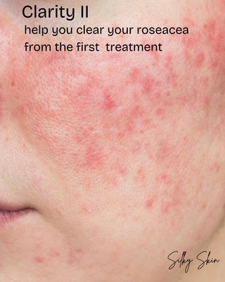 Rosacea Laser treatment - Rosacea is a chronic skin condition causing persistent redness, inflammation, and visible blood vessels, often triggered by environmental and lifestyle factors. Our cutting-edge Nd:YAG laser technology precisely targets and diminishes these symptoms, promoting skin clarity and long-term relief.
This treatment effectively reduces redness and vascular lesions while stimulating collagen production, ensuring healthier skin with each session. Experience comfort, precision, and long-lasting results with our expert-led laser therapy. Rosacea Laser treatment - Rosacea is a chronic skin condition causing persistent redness, inflammation, and visible blood vessels, often triggered by environmental and lifestyle factors. Our cutting-edge Nd:YAG laser technology precisely targets and diminishes these symptoms, promoting skin clarity and long-term relief.
This treatment effectively reduces redness and vascular lesions while stimulating collagen production, ensuring healthier skin with each session. Experience comfort, precision, and long-lasting results with our expert-led laser therapy.