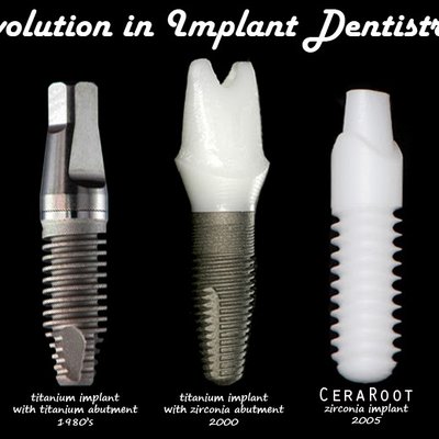 Dental Implants - Dental implants are more stable and last longer than bridges, partials or dentures and may be your best option if you are missing teeth.