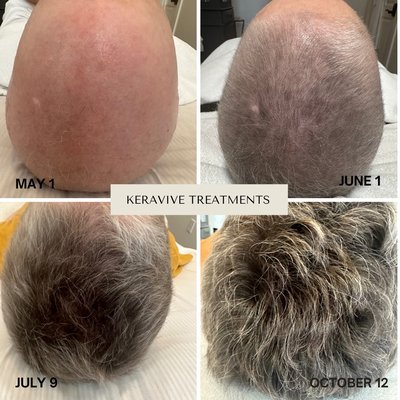 Keravive Hair Loss Treatment - This revolutionary scalp treatment is designed to nourish and hydrate the scalp to promote stronger, healthier hair. Check out these amazing results.