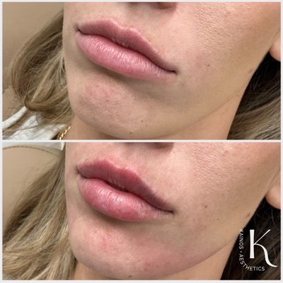 Lips and chin shadowing - Get the perfect pout with the right balance of lip and lower face filler. Lower face filler provides the support your lips need for a natural, enhanced look. Lips and chin shadowing - Get the perfect pout with the right balance of lip and lower face filler. Lower face filler provides the support your lips need for a natural, enhanced look.