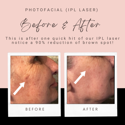 IPL (PhotoFacial) For Brown Spots and Anti-aging - Photo-rejuvenation, commonly utilizing Intense Pulsed Light or IPL, provides a range of benefits for your skin. It effectively reduces hyperpigmentation, enhances skin texture, diminishes redness, and stimulates collagen production. Experience a more youthful and radiant complexion with this innovative treatment. Embrace your skin's natural beauty and let your confidence shine through.
Who should consider the Photo Rejuvenation procedure?
If you are suffering from: Rosacea, Flushing, Age spots, Sun damaged skin, Photo Aging, Mild acne scars, Large Pores, Dark Circles around the eyes, and Fine lines. PhotoFacials leads to the restoration of even-toned, smoother skin.
Photo Rejuvenation and Rosacea?
Rosacea is a skin condition that causes redness and flushing of the skin. Common causes of rosacea include: Exposure to the sun, Alcohol consumption, Aging, Stress, and Medication. The Photo Rejuvenation Procedure reduces the flushed appearance of the skin, minimizing the necessity for antibiotics and cortisone creams.
Our East Setauket photo rejuvenation procedure, also known as a Photo Facial or IPL, is a series of intense light pulses that stimulate collagen production and improve the appearance of:
Dark Spots / Age Spots
Sun Damage
Melasma
Freckles
Rosacea
Uneven Pigmentation
Broken Capillaries and Blood Vessels IPL (PhotoFacial) For Brown Spots and Anti-aging - Photo-rejuvenation, commonly utilizing Intense Pulsed Light or IPL, provides a range of benefits for your skin. It effectively reduces hyperpigmentation, enhances skin texture, diminishes redness, and stimulates collagen production. Experience a more youthful and radiant complexion with this innovative treatment. Embrace your skin's natural beauty and let your confidence shine through.
Who should consider the Photo Rejuvenation procedure?
If you are suffering from: Rosacea, Flushing, Age spots, Sun damaged skin, Photo Aging, Mild acne scars, Large Pores, Dark Circles around the eyes, and Fine lines. PhotoFacials leads to the restoration of even-toned, smoother skin.
Photo Rejuvenation and Rosacea?
Rosacea is a skin condition that causes redness and flushing of the skin. Common causes of rosacea include: Exposure to the sun, Alcohol consumption, Aging, Stress, and Medication. The Photo Rejuvenation Procedure reduces the flushed appearance of the skin, minimizing the necessity for antibiotics and cortisone creams.
Our East Setauket photo rejuvenation procedure, also known as a Photo Facial or IPL, is a series of intense light pulses that stimulate collagen production and improve the appearance of:
Dark Spots / Age Spots
Sun Damage
Melasma
Freckles
Rosacea
Uneven Pigmentation
Broken Capillaries and Blood Vessels