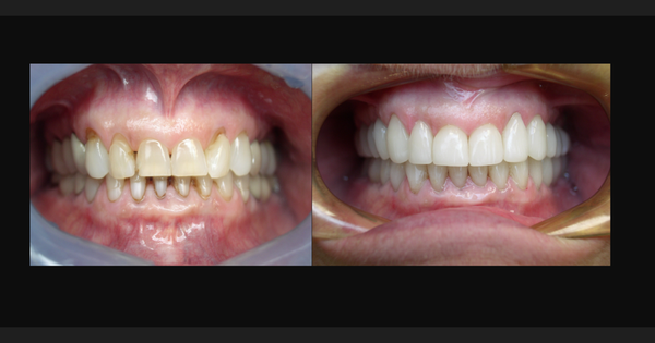 Full Mouth Ceramic Crown Restoration - This case was truly a journey but the final results are remarkable.
The patient came to us with multiple fractured teeth, poor margins on existing restorations, and in need of a deep cleaning. From the very beginning, our priority was to provide comfort, reassurance, and a clear path forward letting them know they were in caring, capable hands.
With the help of our state-of-the-art, modern technology, we’re able to scan, design, and deliver crowns in a single visit. Before beginning treatment, Dr. Jacobs ensured the patient received a thorough deep cleaning to remove built-up plaque and create a healthy foundation for their smile transformation.
From there, we completed a full-mouth ceramic crown restoration, carefully preserving a natural look by matching and enhancing the patient’s original shade creating a result that felt both familiar and beautifully refreshed.
The before-and-after results left the patient truly speechless. They were not only amazed by the transformation, but deeply grateful to see their smile restored with such precision and care.
We’re here to help every patient feel confident and comfortable in their smile just like we did in this case. If you’re ready to begin your own journey, please give us a call at (951) 683-0880. Full Mouth Ceramic Crown Restoration - This case was truly a journey but the final results are remarkable.
The patient came to us with multiple fractured teeth, poor margins on existing restorations, and in need of a deep cleaning. From the very beginning, our priority was to provide comfort, reassurance, and a clear path forward letting them know they were in caring, capable hands.
With the help of our state-of-the-art, modern technology, we’re able to scan, design, and deliver crowns in a single visit. Before beginning treatment, Dr. Jacobs ensured the patient received a thorough deep cleaning to remove built-up plaque and create a healthy foundation for their smile transformation.
From there, we completed a full-mouth ceramic crown restoration, carefully preserving a natural look by matching and enhancing the patient’s original shade creating a result that felt both familiar and beautifully refreshed.
The before-and-after results left the patient truly speechless. They were not only amazed by the transformation, but deeply grateful to see their smile restored with such precision and care.
We’re here to help every patient feel confident and comfortable in their smile just like we did in this case. If you’re ready to begin your own journey, please give us a call at (951) 683-0880.