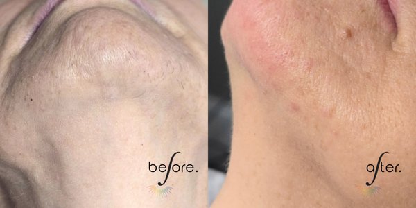 Before/After - Before and After of electrolysis treatments.