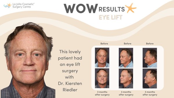 Eyelid Surgery - Are saggy eyelids and puffy under eye bags making you look tired, mad or sad at all times? Eyelid surgery—whether it's for the upper eyelids, lower eyelids, or both—can work wonders. It'll perk you up, make you look refreshed, and bring back your youthful look. Here are before and after photos of blepharoplasty results by the board-certified plastic surgeons at La Jolla Cosmetic Surgery Centre in La Jolla, CA.