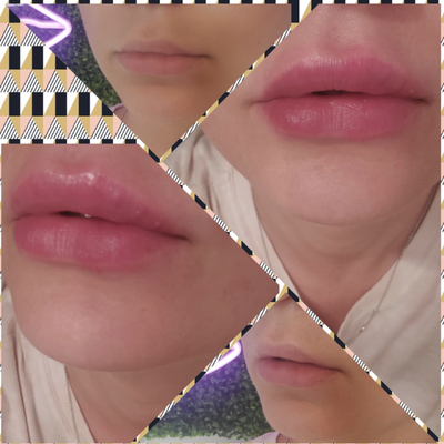 Lip Filler Treatments - I love contributing something extra to clients whenever they need it. When you come to me for my services, I know you are looking for something special — and I deliver just that. For every occasion, I use high quality and long-lasting products. Contact me today and get the look you've always wanted.