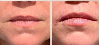 Lip transformations - Lip Transformations:

Special consultations required
