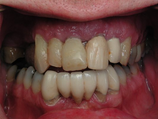 Full Arch Reconstruction - Complete Upper Arch Reconstruction Full Arch Reconstruction - Complete Upper Arch Reconstruction
