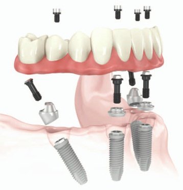 Stonebrook Dental All-on-4 Smile Makeover - A complete smile restoration using All-on-4 implants to replace missing or failing teeth with a secure, natural-looking smile at Stonebrook Dental in Sacramento. Stonebrook Dental All-on-4 Smile Makeover - A complete smile restoration using All-on-4 implants to replace missing or failing teeth with a secure, natural-looking smile at Stonebrook Dental in Sacramento.