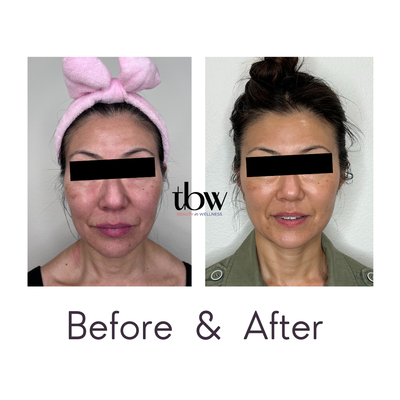 Feel confident without makeup! - After 10 transformative sessions of our bespoke acupuncture facials, including aesthetic acupuncture, facial massage, gua sha, and cupping, our client has achieved remarkably beautiful skin. The noticeable reduction in wrinkles, hyperpigmentation and pores, coupled with a natural lift, has given her the confidence to embrace her natural beauty. Once reliant on makeup to feel presentable, she now proudly showcases her radiant, makeup-free skin!