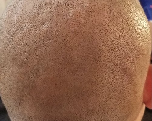 SMP Scar Camouflage - If you have hair transplant scars or general scars, SMP can conceal them and our results are totally natural and completely undetectable.