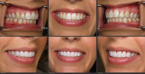 Cosmetic Dental Crowns - Cosmetic Dental Crowns when the so called "dental bonding" fails. The ultimate dental make over Cosmetic Dental Crowns - Cosmetic Dental Crowns when the so called "dental bonding" fails. The ultimate dental make over