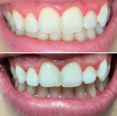 Teeth Whitening - Teeth Whitening Teeth Whitening - Teeth Whitening