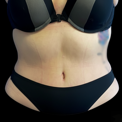 Abdominoplasty (Tummy Tuck) - This portfolio showcases examples of abdominoplasty procedures performed by Dr. Chris Devulapalli at Specialized Plastic Surgery in Westchester, NY.

A tummy tuck can address concerns such as abdominal muscle separation (diastasis recti), excess skin, and stubborn fat that may remain after pregnancy, weight fluctuations, or aging. The procedure helps restore a more supported and contoured abdominal profile that better matches a patient's goals and lifestyle.

Dr. Devulapalli is a board-certified plastic surgeon with specialized training in both aesthetic and reconstructive surgery. His background in advanced microsurgery and soft-tissue reconstruction informs his technique, allowing him to focus on muscle repair, precise skin removal, and natural contouring. He personalizes each surgical plan based on the patient's anatomy, recovery needs, and long-term goals.

Patients choose Specialized Plastic Surgery for Dr. Devulapalli's thorough consultations, clear communication, and comprehensive approach to care. This portfolio highlights the range of outcomes possible through individualized surgical planning and modern abdominoplasty techniques.