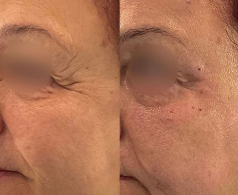 Morpheus8 Treatment for Eyes Area - Sometimes you need surgery, and sometimes you don’t. On both treatment paths, Morpheus8 below you get better results.
Check out the results specifically around the eyes. The loose skin is beginning to retract and tighten. Keep in mind that the recovery process and visible changes continue to improve over the following weeks, and by completing the series.
Morpheus8 targets your full face and is excellent as a stand alone treatment or as a skin tightening prep prior to your facelift or eyelid surgery.
Don't let aging skin hold you back from looking and feeling your best – embrace the power of Morpheus8 for a radiant and youthful complexion.
Book your appointment TODAY!
📞 (310) 272-9988 Morpheus8 Treatment for Eyes Area - Sometimes you need surgery, and sometimes you don’t. On both treatment paths, Morpheus8 below you get better results.
Check out the results specifically around the eyes. The loose skin is beginning to retract and tighten. Keep in mind that the recovery process and visible changes continue to improve over the following weeks, and by completing the series.
Morpheus8 targets your full face and is excellent as a stand alone treatment or as a skin tightening prep prior to your facelift or eyelid surgery.
Don't let aging skin hold you back from looking and feeling your best – embrace the power of Morpheus8 for a radiant and youthful complexion.
Book your appointment TODAY!
📞 (310) 272-9988