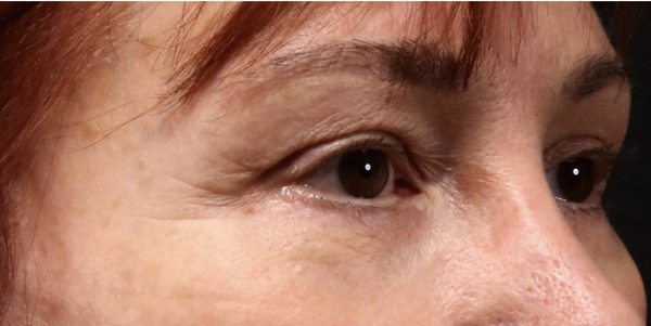 Tixel Skin Rejuvenation - From fine lines to acne scars, Tixel addresses various skin concerns with remarkable results. Our non-invasive treatment stimulates collagen production, leaving you with smoother, tighter, and more youthful-looking skin. Discover the rejuvenating benefits of Tixel today! Tixel Skin Rejuvenation - From fine lines to acne scars, Tixel addresses various skin concerns with remarkable results. Our non-invasive treatment stimulates collagen production, leaving you with smoother, tighter, and more youthful-looking skin. Discover the rejuvenating benefits of Tixel today!
