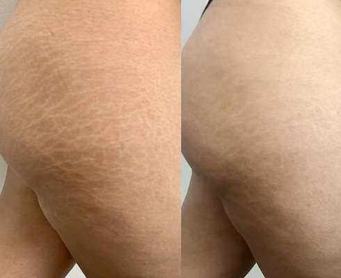 STRETCH MARK CAMOUFLAGE PORTFOLIO - WHAT IS STRETCH MARK CAMOUFLAGE?
The stretch mark camouflage procedure is a form of micropigmentation. Pigments are carefully selected and mixed to match your surrounding skin tone and inserted into the deeper layers of skin using a needling device to correct the colour, making scars or stretch marks appear less visible.
Topical numbing can be used if preferred STRETCH MARK CAMOUFLAGE PORTFOLIO - WHAT IS STRETCH MARK CAMOUFLAGE?
The stretch mark camouflage procedure is a form of micropigmentation. Pigments are carefully selected and mixed to match your surrounding skin tone and inserted into the deeper layers of skin using a needling device to correct the colour, making scars or stretch marks appear less visible.
Topical numbing can be used if preferred