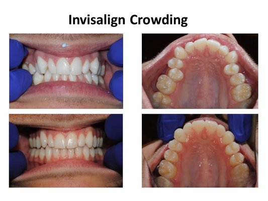 Invisalign - We are a Gold + Invisalign provider with over 14 years experience helping people smile more with Invisalign.