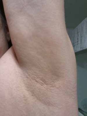 I treated my left underarm and not the right. See the results after two treatments with the IPL for Permanent Hair Reduction. - As an experiment, I treated my left underarm, and not my right. These photos were taken on the same day after only 2 treatments using the IPL Machine for Permanent Hair Reduction. The machine we use at Years Yeung is medical grade and very effective. It is as effective as a 808 diode laser, in the right hands. The only drawback is that it cannot treat dark brown or black skin. Find out if you are a candidate for this painless, fast, effective and reasonable form of hair removal. I treated my left underarm and not the right. See the results after two treatments with the IPL for Permanent Hair Reduction. - As an experiment, I treated my left underarm, and not my right. These photos were taken on the same day after only 2 treatments using the IPL Machine for Permanent Hair Reduction. The machine we use at Years Yeung is medical grade and very effective. It is as effective as a 808 diode laser, in the right hands. The only drawback is that it cannot treat dark brown or black skin. Find out if you are a candidate for this painless, fast, effective and reasonable form of hair removal.