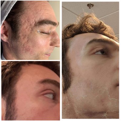 Acne Treatment - Active acne and acne screen reduction removal treatment using multiple modalities such as chemical peels radio, frequency, micro, needling, micro dermabrasion, micro, needling, nano fusion and facials Acne Treatment - Active acne and acne screen reduction removal treatment using multiple modalities such as chemical peels radio, frequency, micro, needling, micro dermabrasion, micro, needling, nano fusion and facials