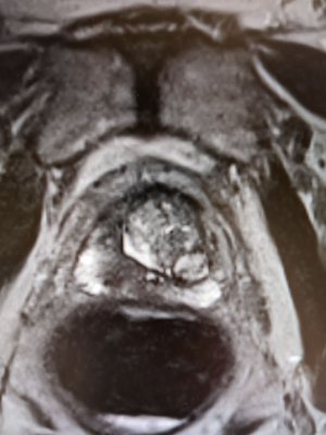 HIFU - High-intensity focused ultrasound - We offer a groundbreaking approach to treating localized prostate cancer. Instead of traditional methods that can lead to urinary leakage and erectile dysfunction, we specialize in focal ablation. Our precise and minimally invasive technique targets only the affected area, preserving your quality of life. Experience cutting-edge care that prioritizes your health and well-being.
Patient went home the same day with a foley catheter for 5 days. HIFU - High-intensity focused ultrasound - We offer a groundbreaking approach to treating localized prostate cancer. Instead of traditional methods that can lead to urinary leakage and erectile dysfunction, we specialize in focal ablation. Our precise and minimally invasive technique targets only the affected area, preserving your quality of life. Experience cutting-edge care that prioritizes your health and well-being.
Patient went home the same day with a foley catheter for 5 days.