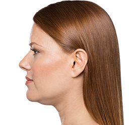 Kybella - Kybella is the first and the only FDA approved non-surgical injectable treatment to improve moderate to sever fat under the chin by physically destroying fat cells in the treatment area. Kybella - Kybella is the first and the only FDA approved non-surgical injectable treatment to improve moderate to sever fat under the chin by physically destroying fat cells in the treatment area.