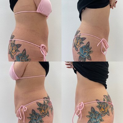 Body Sculpting - Body sculpting is breaking down / liquidating fat & then draining it through your lymphatic system. It works the best with good hydration, good diet & brisk exercises. 
Typically someone would need 3-12 treatments.