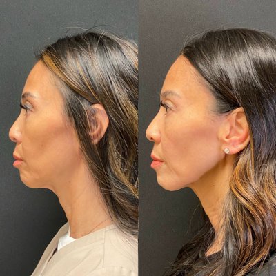 XERF Treatment - This treatment was done with the new latest and greatest technology for skin tightening, laxity, and firmness. No numbing, no needles, no downtime. This was instant results after 1 treatment (results may vary). XERF Treatment - This treatment was done with the new latest and greatest technology for skin tightening, laxity, and firmness. No numbing, no needles, no downtime. This was instant results after 1 treatment (results may vary).
