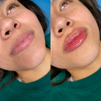 Lip Fillers - We offer of 1 ML, 1.5 ML or 2 ML Lip Fillers - We offer of 1 ML, 1.5 ML or 2 ML