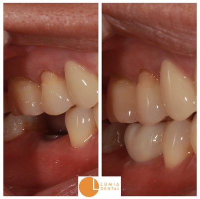 Dental Implants & Gum Surgery - Dr. Lydia Gardner is our board-certified periodontist and providers full range of dental surgeries, including dental implants, tooth extractions, sinus lifts, gum lifts, gum grafts, and laser dental treatment. Our restorative and cosmetic dentists Drs. Michelle Han, Jacob Donohue, and Markelle Smith take care of restoring the teeth beautifully after surgery is performed. Dental Implants & Gum Surgery - Dr. Lydia Gardner is our board-certified periodontist and providers full range of dental surgeries, including dental implants, tooth extractions, sinus lifts, gum lifts, gum grafts, and laser dental treatment. Our restorative and cosmetic dentists Drs. Michelle Han, Jacob Donohue, and Markelle Smith take care of restoring the teeth beautifully after surgery is performed.