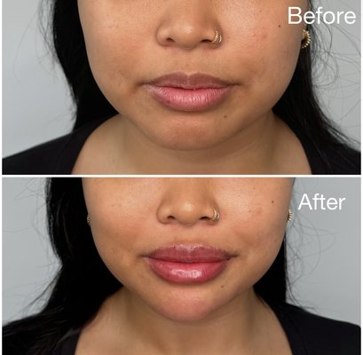 Lip Enhancement - Refined lip enhancement with soft balanced volume and a smooth hydrated finish for an effortlessly elevated look Lip Enhancement - Refined lip enhancement with soft balanced volume and a smooth hydrated finish for an effortlessly elevated look