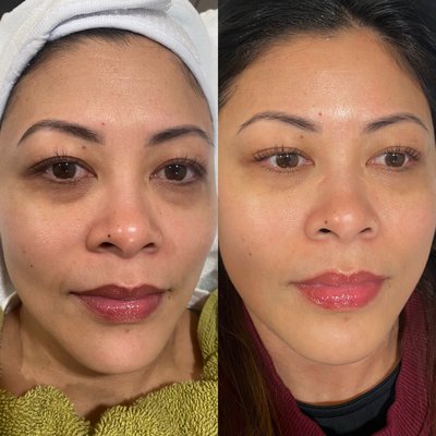 Eye treatment and Green Sea Peel - Client had several eye treatments to treat her under eyes dark circle. Also did a Green Sea Peel to brighten and even out her skin tone. Eye treatment and Green Sea Peel - Client had several eye treatments to treat her under eyes dark circle. Also did a Green Sea Peel to brighten and even out her skin tone.