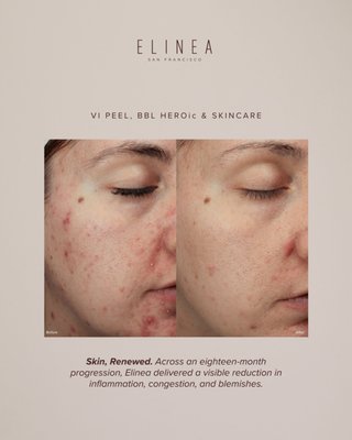 INFLAMED ACNE, REDNESS & TEXTURE - Elinea providers designed a tailored protocol combining VI Peel, BBL HEROic, and a custom skincare regimen — delivered over an eighteen month active treatment period, with ongoing skincare and check-ins to maintain results.