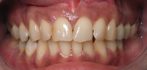 Smile Makeover - Simple Veneers - Ariyah wanted a beautiful smile with brighter teeth.  She did not present with a difficult situation but achieving a look that matched her facial contours and overall personality was the challenge.

With simple and conservative veneer preparations, Ariyah was able to chieve the smile of her dreams in just 2 visits.