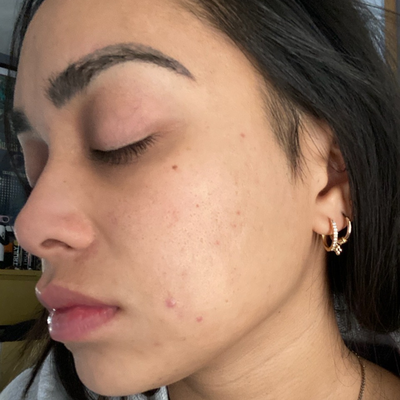 PCA Skin Chemical Peels - Great for All Skin Types & Ethnic Backgrounds. 
Improve Texture, Tone, Clarity, & Complexion!
Book your chemical peel today!
