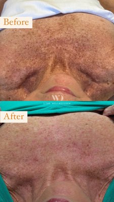 BBL/Moxi Combo treatment - Moxi and BBL laser work together to deliver powerful, transformative results—giving you smoother, clearer, and more youthful-looking skin!

🔹 Moxi Laser is perfect for melasma, sun damage, uneven skin tone, and signs of aging, plus it's FDA-cleared to treat actinic keratosis, a precancerous skin condition.
🔹 BBL (Broadband Light) laser targets age spots, rosacea, acne scars, fine lines, broken capillaries, and pigmentation issues—all while boosting skin clarity.

When combined, these two treatments supercharge your skin’s renewal, leaving you with brighter, healthier, and more even-toned skin with minimal downtime