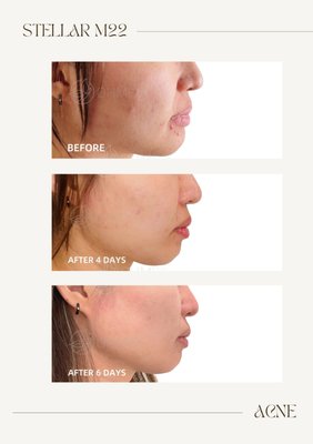 Acne Treatment - We love to see our customers AMAZING results!
😣 Skin Concern:Active Acne
💫 Treatment: #stellarm22
⏳ 1 treatment -> After 4 DAYS -> After 6 DAYS
💛Eliminates bacteria within pores
💛Improves skin appearance
💛A great alternative for oral medication
💛No downtime, and yield long-term benefits Acne Treatment - We love to see our customers AMAZING results!
😣 Skin Concern:Active Acne
💫 Treatment: #stellarm22
⏳ 1 treatment -> After 4 DAYS -> After 6 DAYS
💛Eliminates bacteria within pores
💛Improves skin appearance
💛A great alternative for oral medication
💛No downtime, and yield long-term benefits