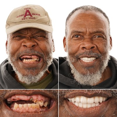 Bill's Journey to a New Smile with Dental Implants - Bill knew it was time for a change when his 2-year-old nephew looked at him and asked, “Uncle Bill, what’s wrong with your teeth?” That moment stuck with him, and pushed him to finally take the step toward dental implants. Now, with his new smile, Bill says he’s proud to show it off to anyone who used to give him a second glance. He trusted Louisiana Implants & Dentures because of their transparency, friendliness, and personal approach, and couldn’t be happier with the results!