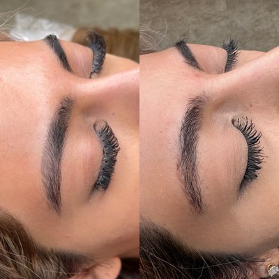 Eyebrow Tattoo Removal - Laser eyebrow tattoo removal Eyebrow Tattoo Removal - Laser eyebrow tattoo removal