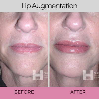 Lip Augmentation - Restore A Youthful & Self-Assured Appearance!
Our goal is to create a discreet, caring environment where you feel safe to honestly express your wishes and receive highly personalized options that will achieve your aesthetic goals. With over 25 years of experience, Dr. Hall’s approach to patients is to treat each one as an individual and commit the time and effort to do what is best for them.