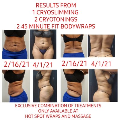 Cryotoning for PERFECT BBL $250 INTRO SPECIAL - CRYO-TONING PERFECT BBL
THIS TREATMENT REDUCES THE APPEARANCE OF CELLULITE WHILE LIFTING AND GIVING THAT PERFECT APPLE BOTTOM SHAPE! YOU'LL Cryotoning for PERFECT BBL $250 INTRO SPECIAL - CRYO-TONING PERFECT BBL
THIS TREATMENT REDUCES THE APPEARANCE OF CELLULITE WHILE LIFTING AND GIVING THAT PERFECT APPLE BOTTOM SHAPE! YOU'LL