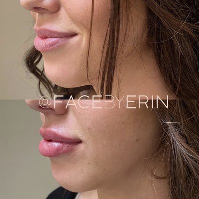 Lip Filler - Lip Filler
