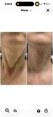 Skin Booster Treatments - Skin Booster Treatments Skin Booster Treatments - Skin Booster Treatments