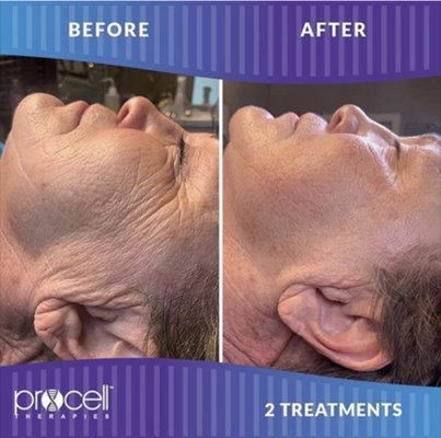 Procell Treatments - ProCell Treatments offer cutting-edge biotechnology to induce a breathtaking transformation to the appearance of the skin that can last a lifetime. Anything from Acne, Hair-loss, Skin tightening, Wrinkles and Fine lines, and more Procell microchanneling has got you covered!